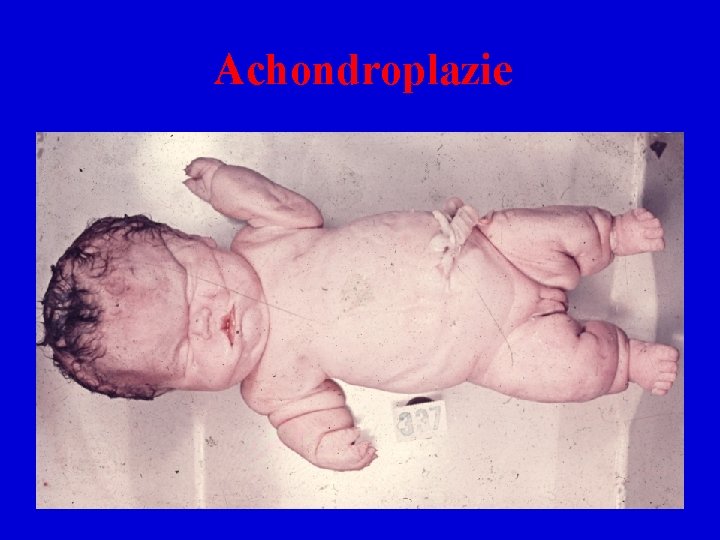 Achondroplazie 