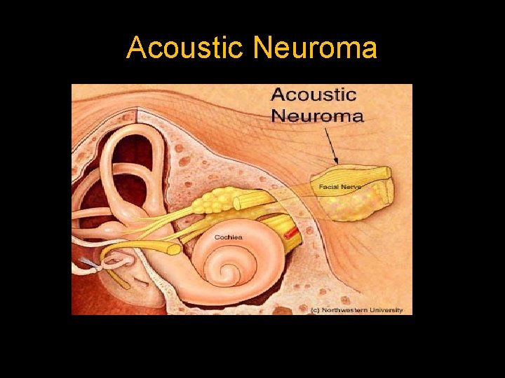 Acoustic Neuroma 