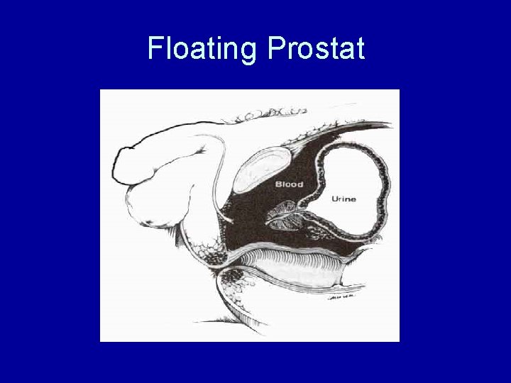 Floating Prostat 