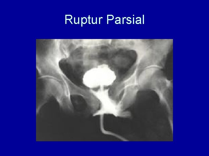 Ruptur Parsial 