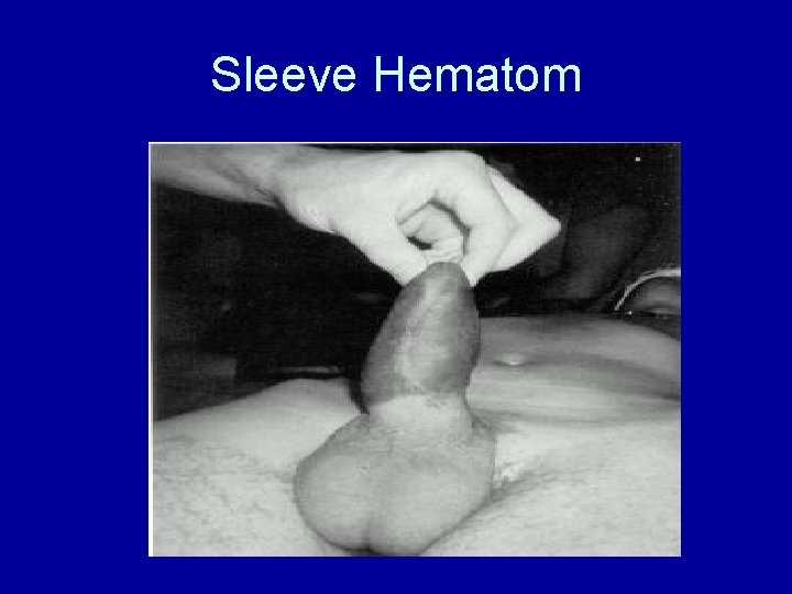 Sleeve Hematom 