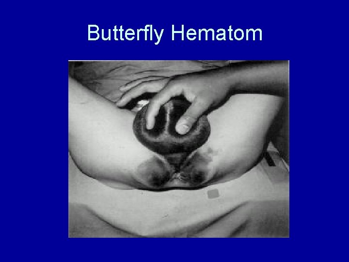 Butterfly Hematom 