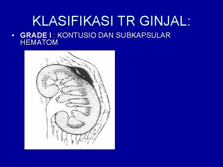 KLASIFIKASI TR GINJAL: • GRADE I : KONTUSIO DAN SUBKAPSULAR HEMATOM 