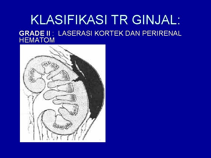 KLASIFIKASI TR GINJAL: GRADE II : LASERASI KORTEK DAN PERIRENAL HEMATOM 