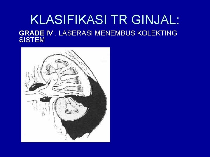 KLASIFIKASI TR GINJAL: GRADE IV : LASERASI MENEMBUS KOLEKTING SISTEM 