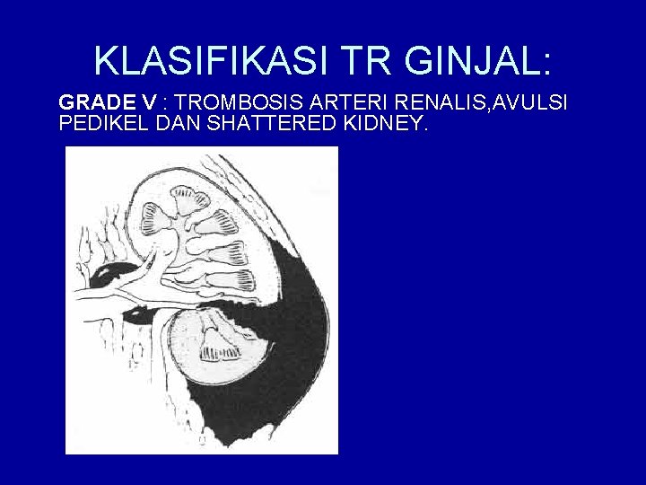 KLASIFIKASI TR GINJAL: GRADE V : TROMBOSIS ARTERI RENALIS, AVULSI PEDIKEL DAN SHATTERED KIDNEY.
