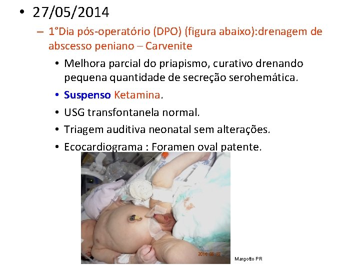  • 27/05/2014 – 1°Dia pós-operatório (DPO) (figura abaixo): drenagem de abscesso peniano –