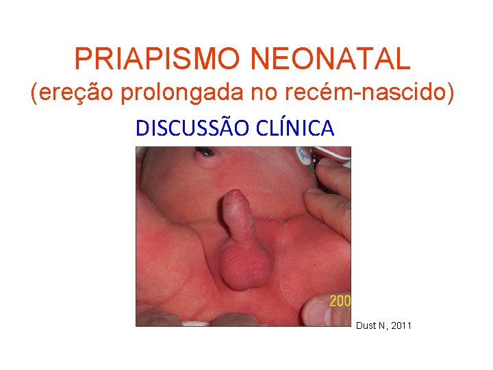 PRIAPISMO NEONATAL (ereção prolongada no recém-nascido) DISCUSSÃO CLÍNICA Dust N, 2011 