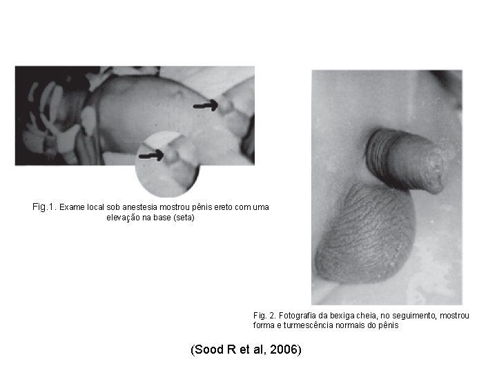 Fig. 1. Exame local sob anestesia mostrou pênis ereto com uma elevação na base