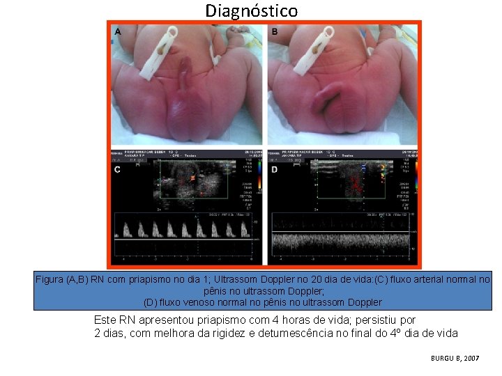 Diagnóstico Figura (A, B) RN com priapismo no dia 1; Ultrassom Doppler no 20