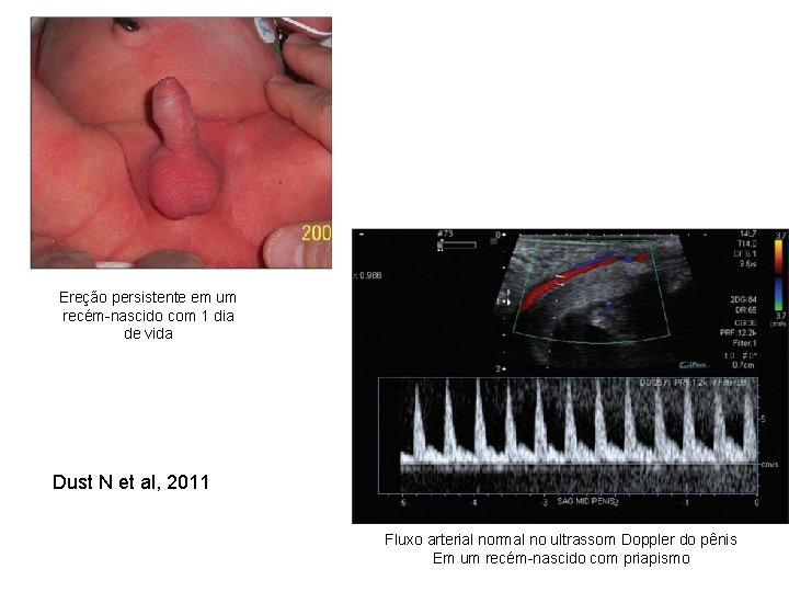 Ereção persistente em um recém-nascido com 1 dia de vida Dust N et al,