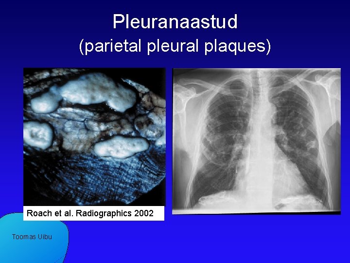 Pleuranaastud (parietal pleural plaques) Roach et al. Radiographics 2002 Toomas Uibu 