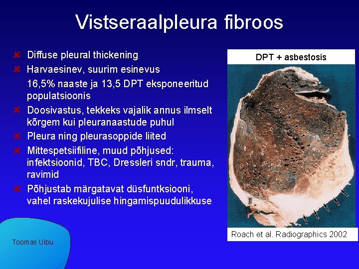 Vistseraalpleura fibroos Diffuse pleural thickening Harvaesinev, suurim esinevus 16, 5% naaste ja 13, 5