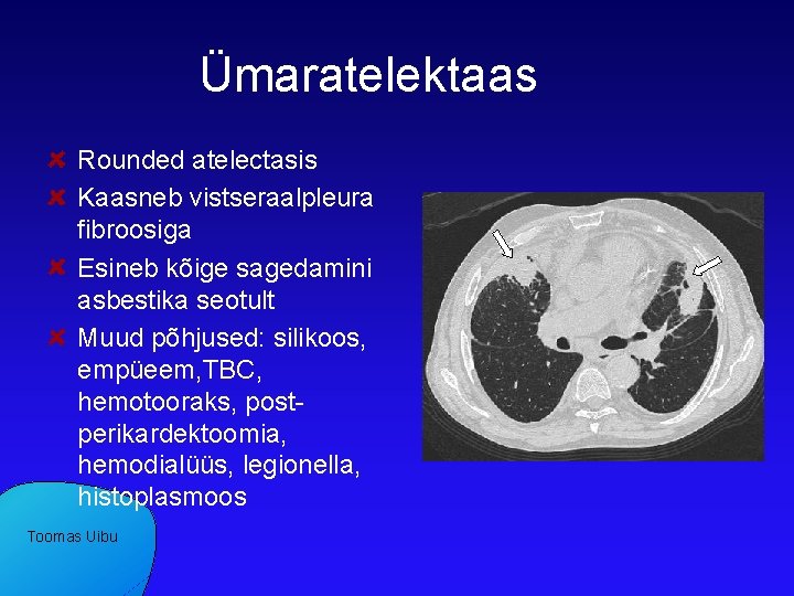 Ümaratelektaas Rounded atelectasis Kaasneb vistseraalpleura fibroosiga Esineb kõige sagedamini asbestika seotult Muud põhjused: silikoos,