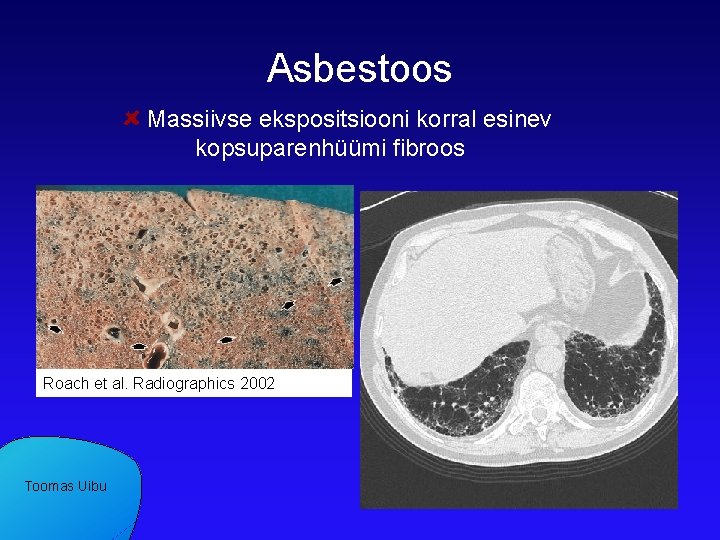 Asbestoos Massiivse ekspositsiooni korral esinev kopsuparenhüümi fibroos Roach et al. Radiographics 2002 Toomas Uibu
