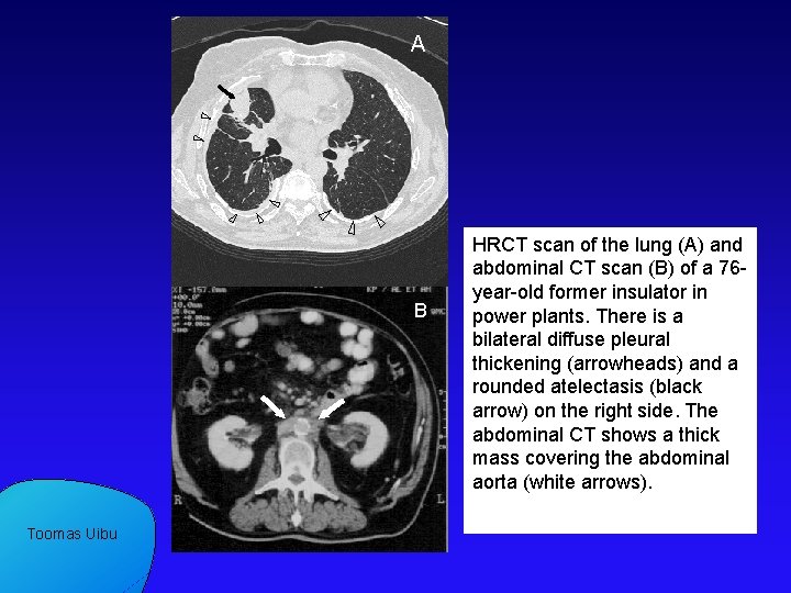 A B Toomas Uibu HRCT scan of the lung (A) and abdominal CT scan