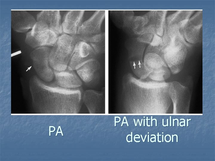 PA PA with ulnar deviation 