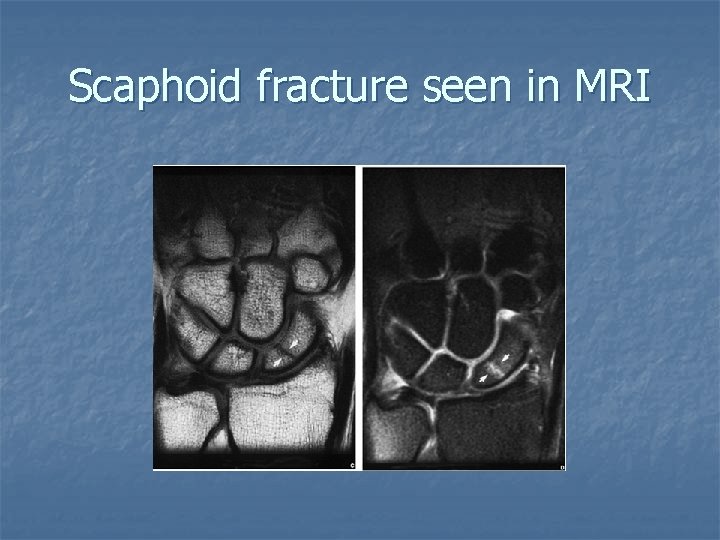 Scaphoid fracture seen in MRI 