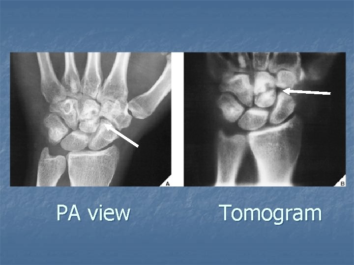 PA view Tomogram 