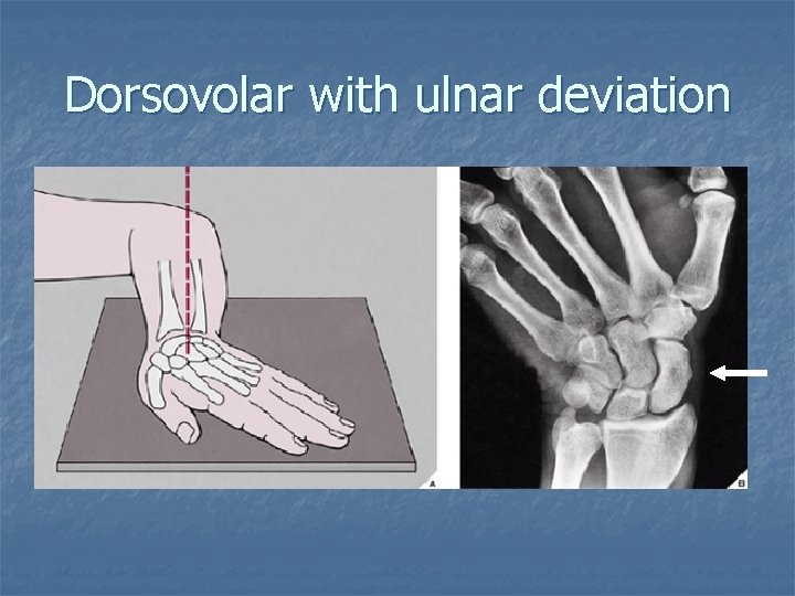 Dorsovolar with ulnar deviation 