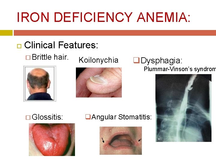 IRON DEFICIENCY ANEMIA: Clinical Features: � Brittle hair. Koilonychia q. Dysphagia: Plummar-Vinson’s syndrom �