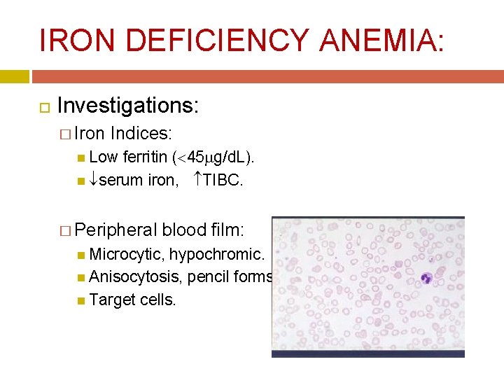 IRON DEFICIENCY ANEMIA: Investigations: � Iron Indices: Low ferritin ( 45 g/d. L). serum