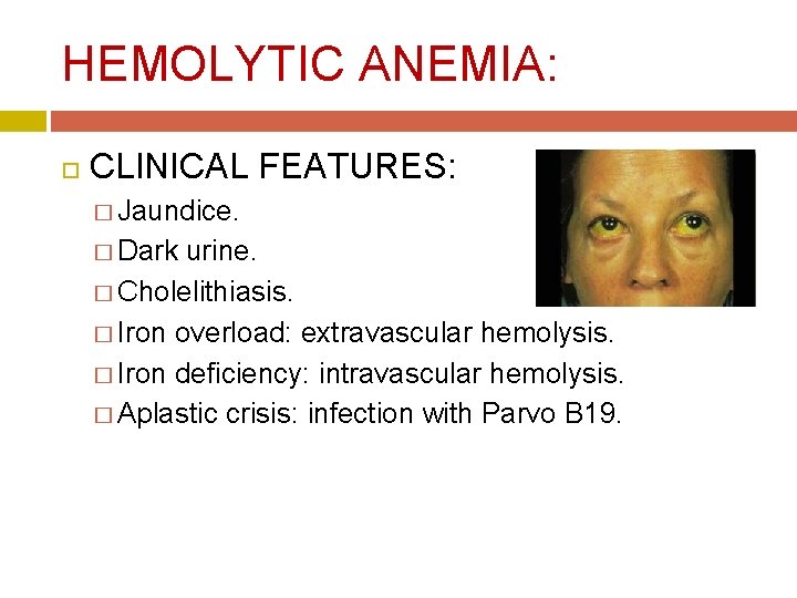 HEMOLYTIC ANEMIA: CLINICAL FEATURES: � Jaundice. � Dark urine. � Cholelithiasis. � Iron overload: