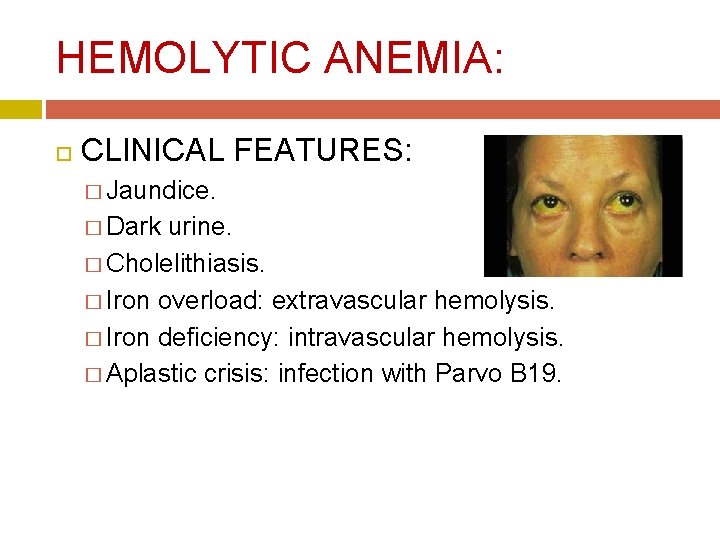 HEMOLYTIC ANEMIA: CLINICAL FEATURES: � Jaundice. � Dark urine. � Cholelithiasis. � Iron overload: HEMOLYTIC ANEMIA: CLINICAL FEATURES: � Jaundice. � Dark urine. � Cholelithiasis. � Iron overload: