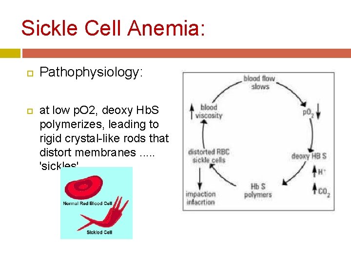 Sickle Cell Anemia: Pathophysiology: at low p. O 2, deoxy Hb. S polymerizes, leading