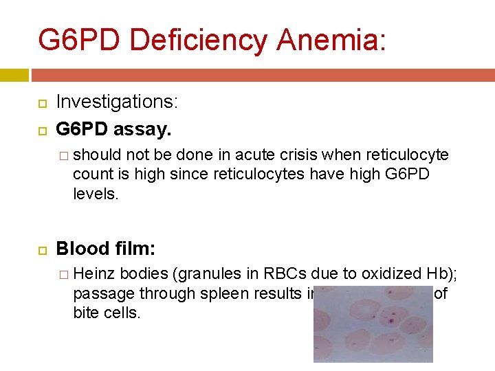 G 6 PD Deficiency Anemia: Investigations: G 6 PD assay. � should not be G 6 PD Deficiency Anemia: Investigations: G 6 PD assay. � should not be