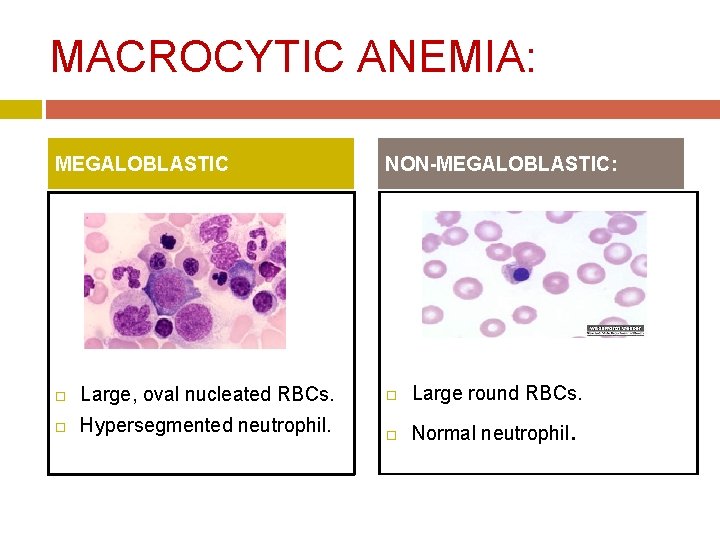 MACROCYTIC ANEMIA: MEGALOBLASTIC NON-MEGALOBLASTIC: Large, oval nucleated RBCs. Large round RBCs. Hypersegmented neutrophil. Normal MACROCYTIC ANEMIA: MEGALOBLASTIC NON-MEGALOBLASTIC: Large, oval nucleated RBCs. Large round RBCs. Hypersegmented neutrophil. Normal