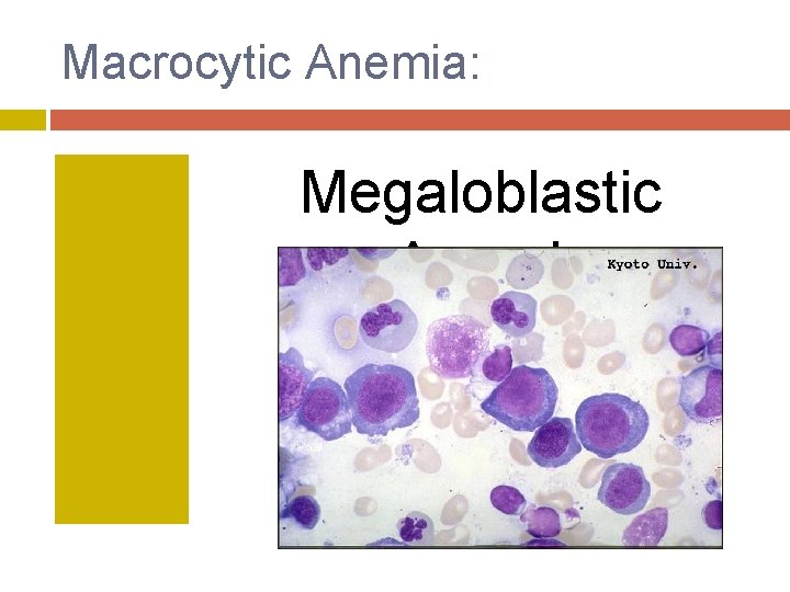 Macrocytic Anemia: Megaloblastic Anemia 