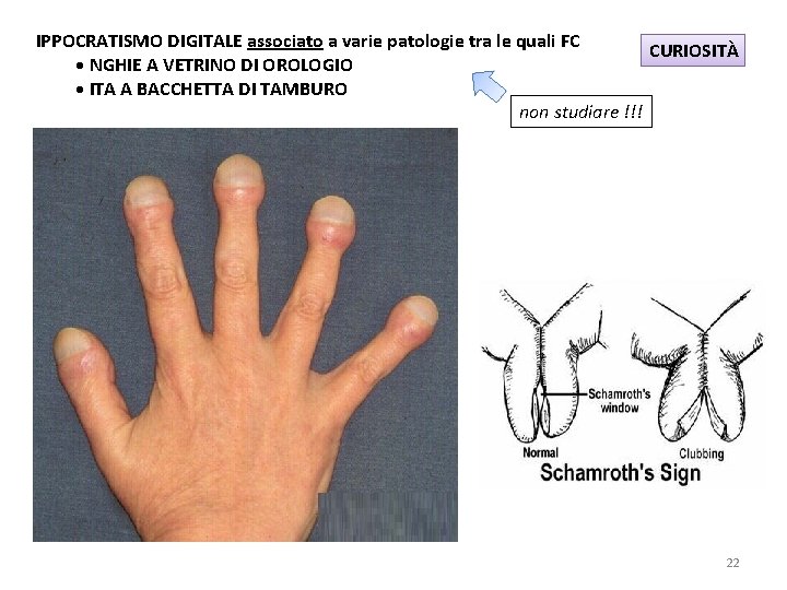 IPPOCRATISMO DIGITALE associato a varie patologie tra le quali FC CURIOSITÀ •  NGHIE A