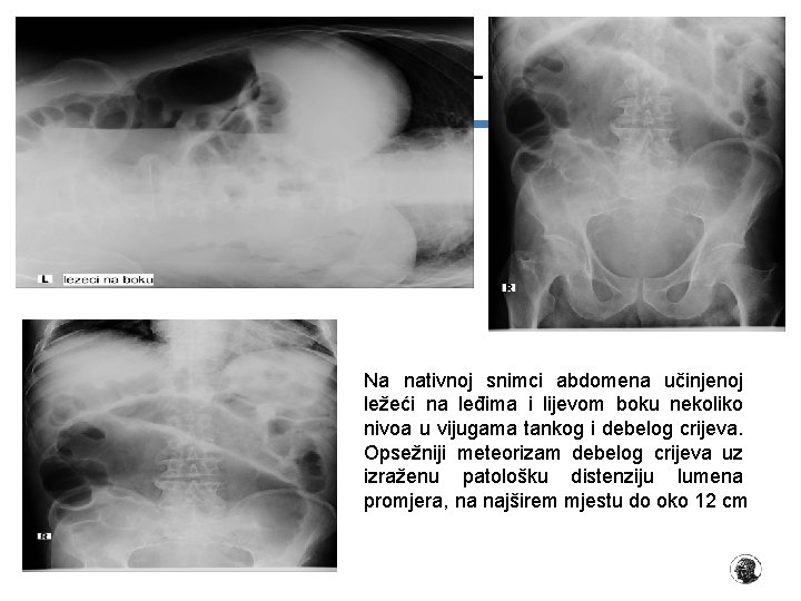 PRIKAZ BOLESNIKA (3) – LIJEČENJE Na nativnoj snimci abdomena učinjenoj ležeći na leđima i