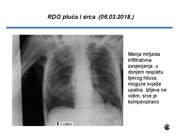 RDG pluća i srca (06. 03. 2018. ) Manja mrljasta infiltrativna zasjenjenja u donjem