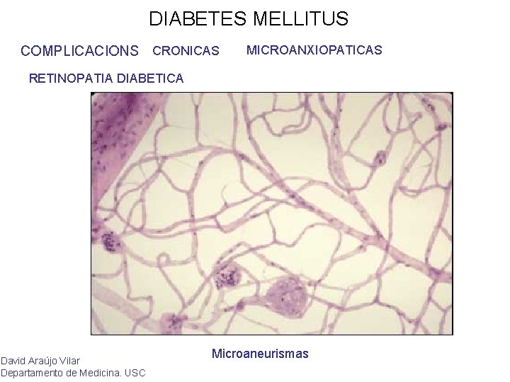 DIABETES MELLITUS COMPLICACIONS CRONICAS MICROANXIOPATICAS RETINOPATIA DIABETICA David Araújo Vilar Departamento de Medicina. USC