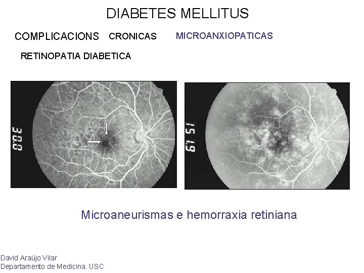 DIABETES MELLITUS COMPLICACIONS CRONICAS MICROANXIOPATICAS RETINOPATIA DIABETICA Microaneurismas e hemorraxia retiniana David Araújo Vilar