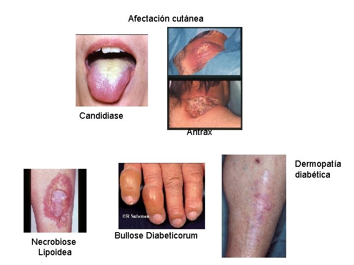 Afectación cutánea Candidiase Antrax Dermopatía diabética Necrobiose Lipoidea Bullose Diabeticorum 