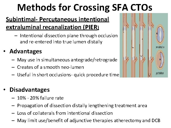 Methods for Crossing SFA CTOs Subintimal- Percutaneous intentional extraluminal recanalization (PIER) – Intentional dissection
