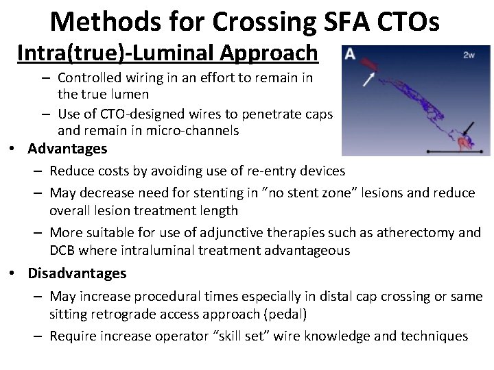 Methods for Crossing SFA CTOs Intra(true)-Luminal Approach – Controlled wiring in an effort to