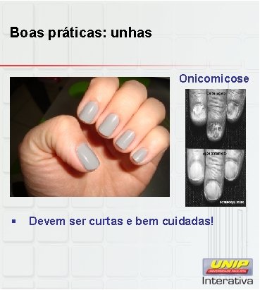 Boas práticas: unhas Onicomicose § Devem ser curtas e bem cuidadas! 