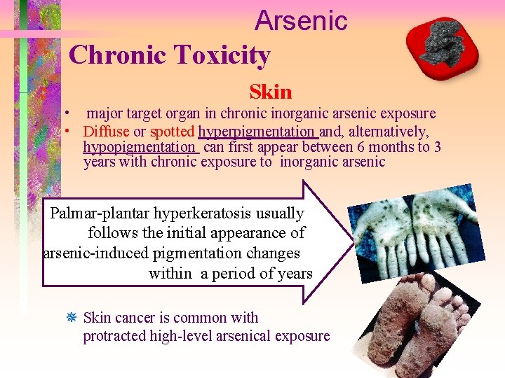 Arsenic Chronic Toxicity Skin • major target organ in chronic inorganic arsenic exposure •