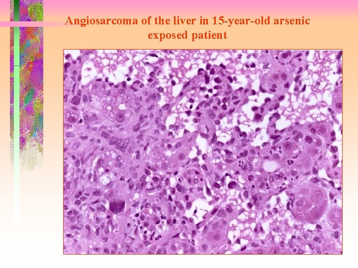Angiosarcoma of the liver in 15 -year-old arsenic exposed patient 