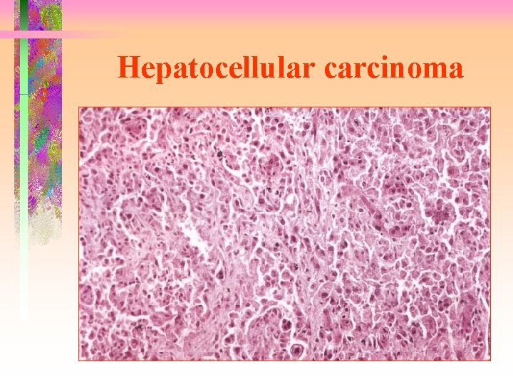 Hepatocellular carcinoma 