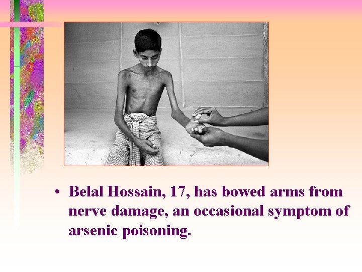  • Belal Hossain, 17, has bowed arms from nerve damage, an occasional symptom