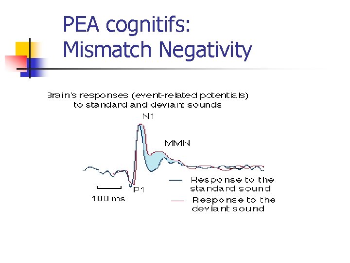 PEA cognitifs: Mismatch Negativity 