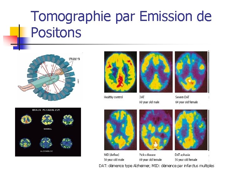 Tomographie par Emission de Positons DAT: démence type Alzheimer; MID: démence par infarctus multiples