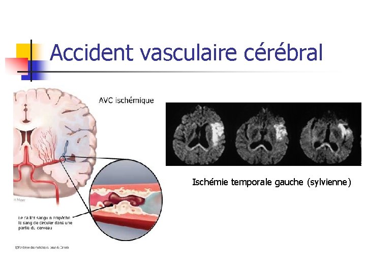 Accident vasculaire cérébral Ischémie temporale gauche (sylvienne) 