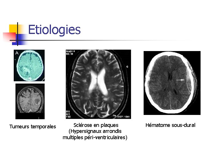 Etiologies Tumeurs temporales Sclérose en plaques (Hypersignaux arrondis multiples péri-ventriculaires) Hématome sous-dural 