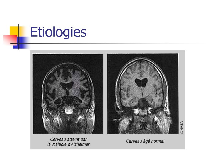 Etiologies 